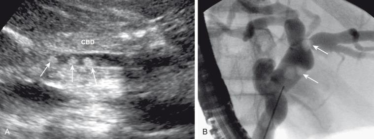 Figure 88.4, Choledocholithiasis in a 15-year-old girl with sickle cell disease and abdominal pain.