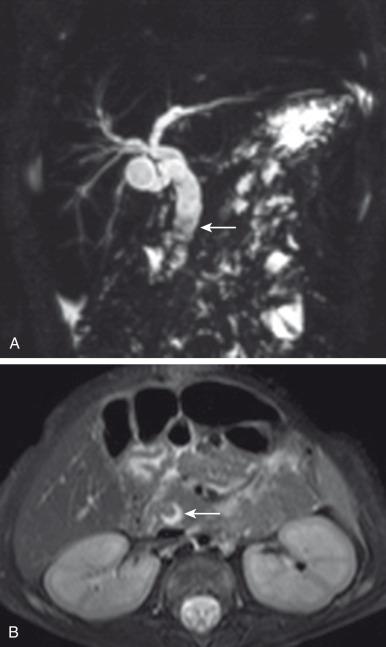 Figure 88.5, Choledocholithiasis in a 3-month-old baby with prior history of congenital diaphragmatic hernia.