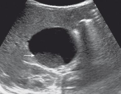 e-Figure 88.6, Biliary sludge in a 1-year-old boy with a choledochal cyst.