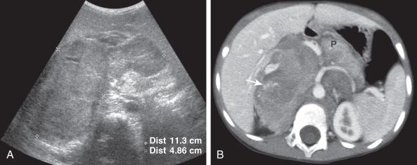 Figure 122.1, Retroperitoneal neuroblastoma in a 4-year-old boy.