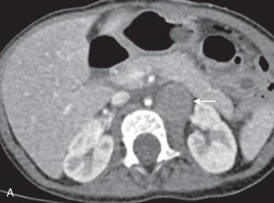Figure 122.2, Incidentally detected small neuroblastoma in a 2-year-old boy.