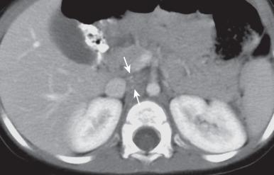 eFigure 122.3, Retroperitoneal neuroblastoma in a 19-month-old boy presenting with ataxia and nystagmus.