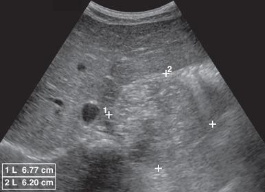 e-Figure 122.5, Left adrenal neuroblastoma in a 7-year-old girl.