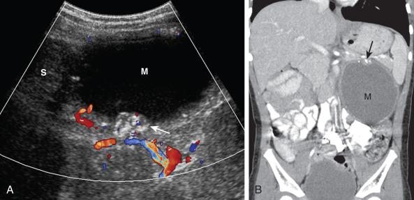 e-Figure 122.6, Left adrenal neuroblastoma in a 3-year-old girl.