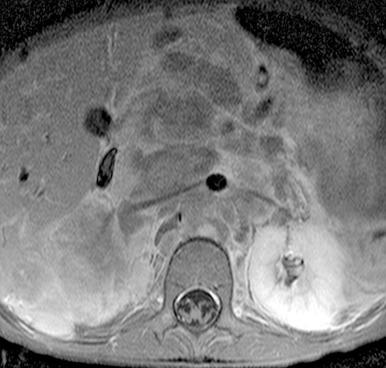 Figure 122.7, Retroperitoneal neuroblastoma in a 4-year-old girl.