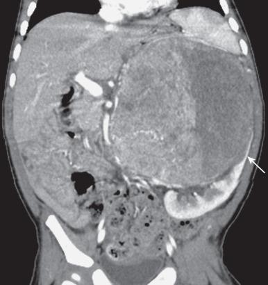 Figure 122.8, Left adrenal neuroblastoma in a 9-month-old girl.
