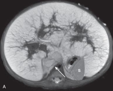 Figure 122.9, Metastatic liver disease in neuroblastoma in an 8-day-old girl (stage MS [formerly 4S]).