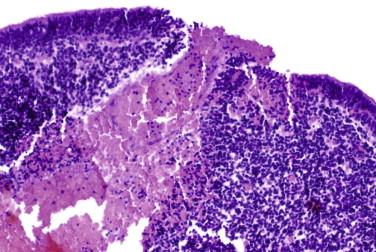 Fig 4, Germinal matrix hemorrhage. Hemorrhages can readily dissect through the stroma-poor GMZ and enter the adjacent ventricle.