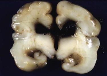 Fig 5, Intraventricular hemorrhage/hematoma. An acute blood clot fills the right lateral ventricle. Such hemorrhages may extend throughout the pathways of CSF flow.