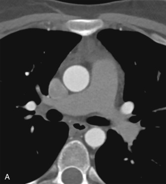 Figure 29.1, Normal aortic anatomy on CT angiogram. (A) Axial CT angiogram image of a normal ascending and descending aorta. The normal thoracic aorta measures less than 4 cm. (B) Sagittal oblique maximum intensity projection of a normal thoracic aorta demonstrates its extension from the aortic root to the diaphragm. It has conventional three-vessel branching. The great vessels typically arise from the aortic arch in the following order: right brachiocephalic (straight arrow), left common carotid (arrowhead), and left subclavian (curved arrow) arteries.