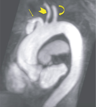 Figure 29.2, Sagittal oblique maximum intensity projection reformat of a contrast-enhanced MR angiogram, demonstrating normal contours of the thoracic aortic arch and branching to the right brachiocephalic (straight arrow), left common carotid (arrowhead), and left subclavian (curved arrow) arteries.