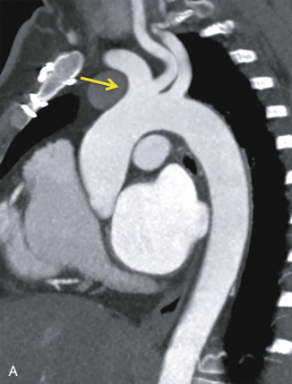 Figure 29.3, Two-vessel arch. (A) Sagittal oblique maximum intensity projection reformatted images of a CT angiogram and (B) contrast-enhanced MR angiogram in two patients with a bovine aortic arch. Note the two-vessel configuration resulting from a common origin of the right brachiocephalic and left common carotid arteries (arrows).