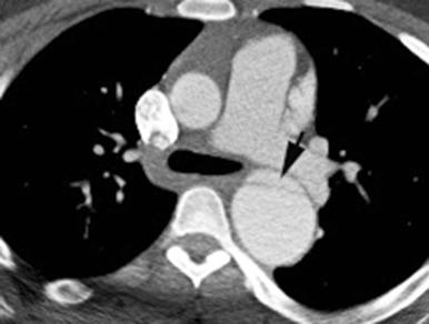 Figure 82.1, Aortic dissection in a 16-year-old male with Marfan syndrome who presented with chest pain.