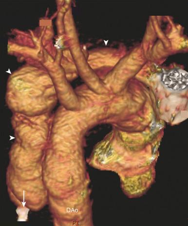 Figure 82.2, False aortic aneurysm from a gunshot wound in an 18-year-old male.