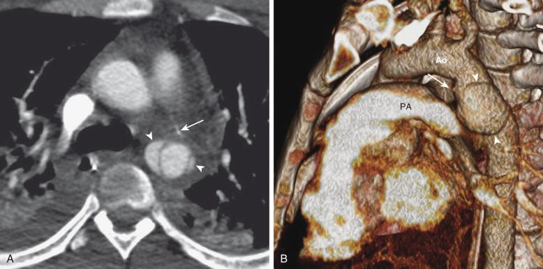 Figure 82.3, Aortic rupture in a 16-year-old boy as a result of a motor vehicle accident.