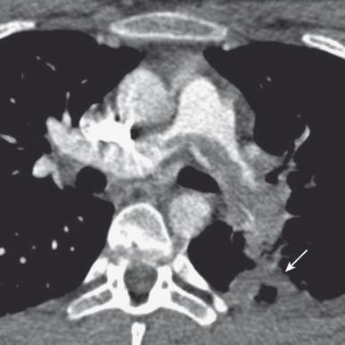 Figure 82.4, Saddle pulmonary embolus in a 15-year-old girl who recently started taking oral contraceptive pills.