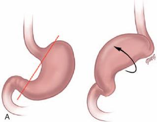 Figure 101.2, Schematic drawing illustrating gastric volvulus.