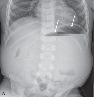 Figure 101.3, Mesenteroaxial volvulus and wandering spleen.