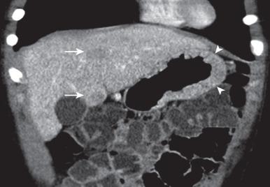 Figure 101.4, Zollinger-Ellison syndrome secondary to a pancreatic gastrinoma in a 10-year-old boy.