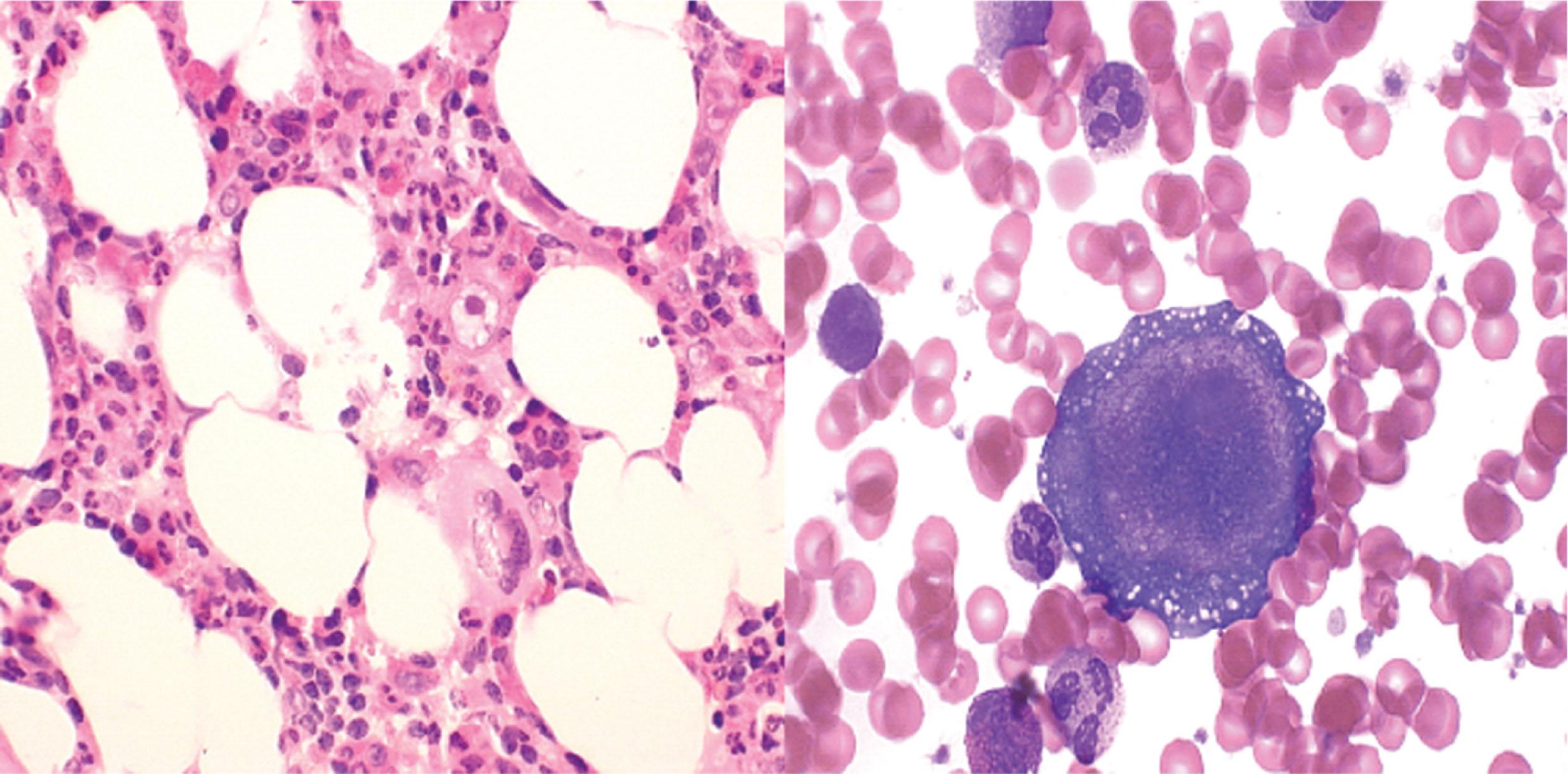 Figure 33.2, PARVOVIRUS B19–MEDIATED PURE RED CELL APLASIA.