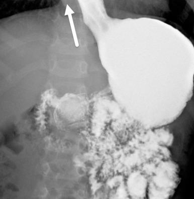 Figure 98.1, Gastroesophageal reflux.