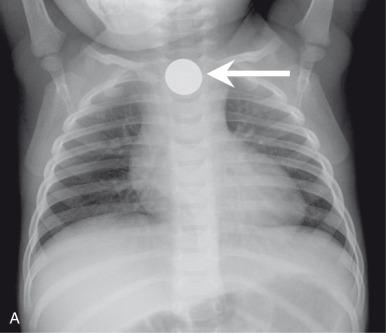 e-Figure 98.2, Coin in esophagus.