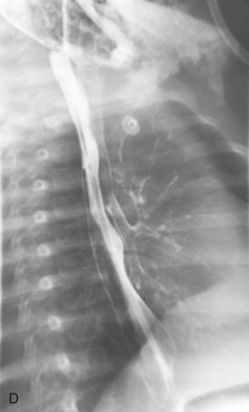 e-Figure 98.3, (D) Oblique view from an esophagram shows contrast in both the esophagus and the tracheobronchial tree due to the tracheoesophageal fistula.