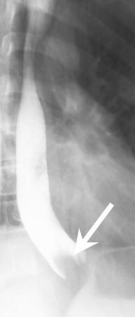 e-Figure 98.4, Esophagram shows a persistent filling defect (arrow) in the distal esophagus. The patient underwent endoscopy to remove the food bolus. The biopsy obtained during endoscopy confirmed a diagnosis of eosinophilic esophagitis.