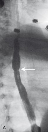 Figure 98.5, Stricture and other complications of caustic ingestion.