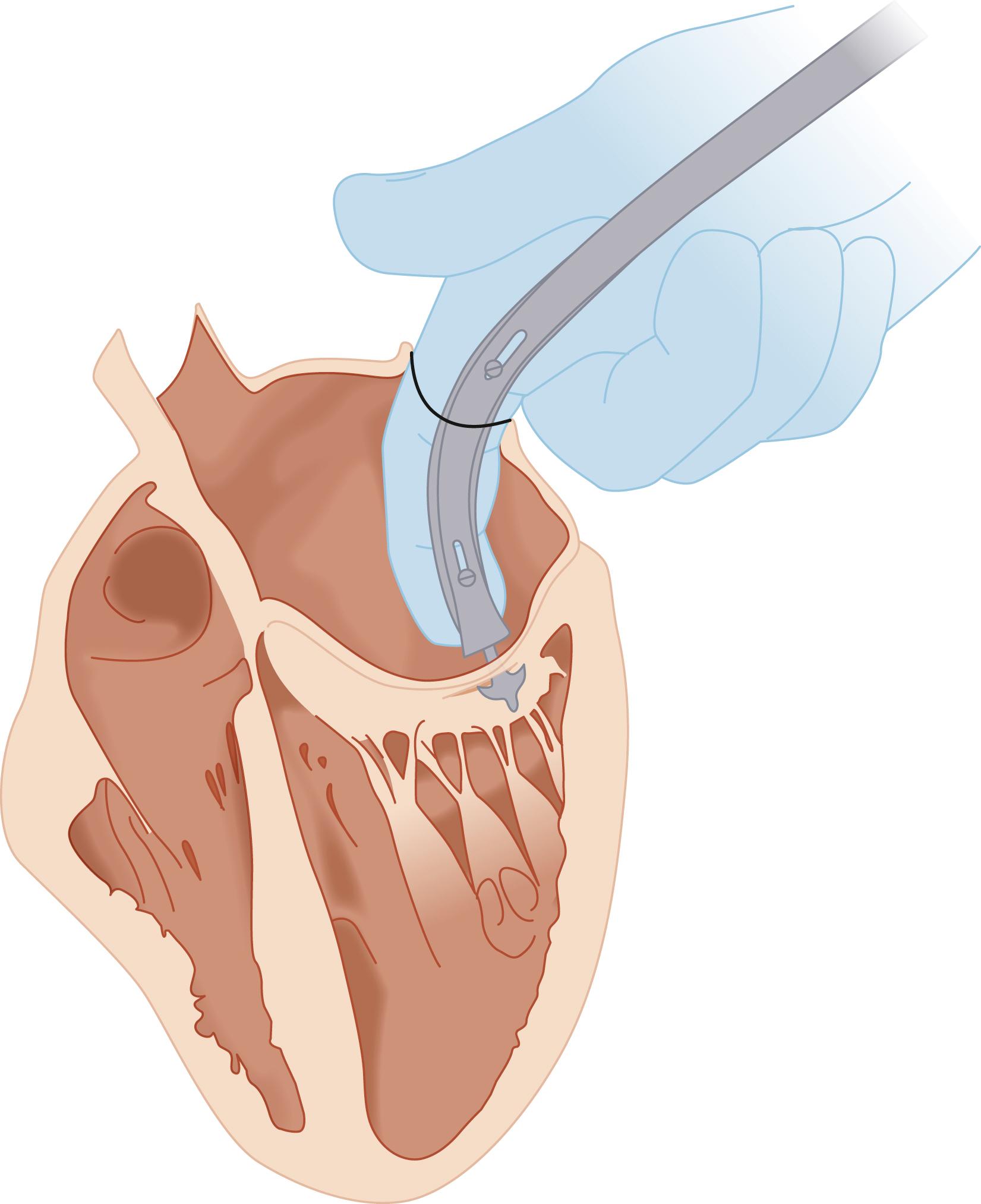 Fig. 61.1, Closed mitral commissurotomy. Dwight Harken developed a closed mitral commissurotomy procedure to correct rheumatic mitral stenosis that became the first widespread approach to treating valvular heart disease.