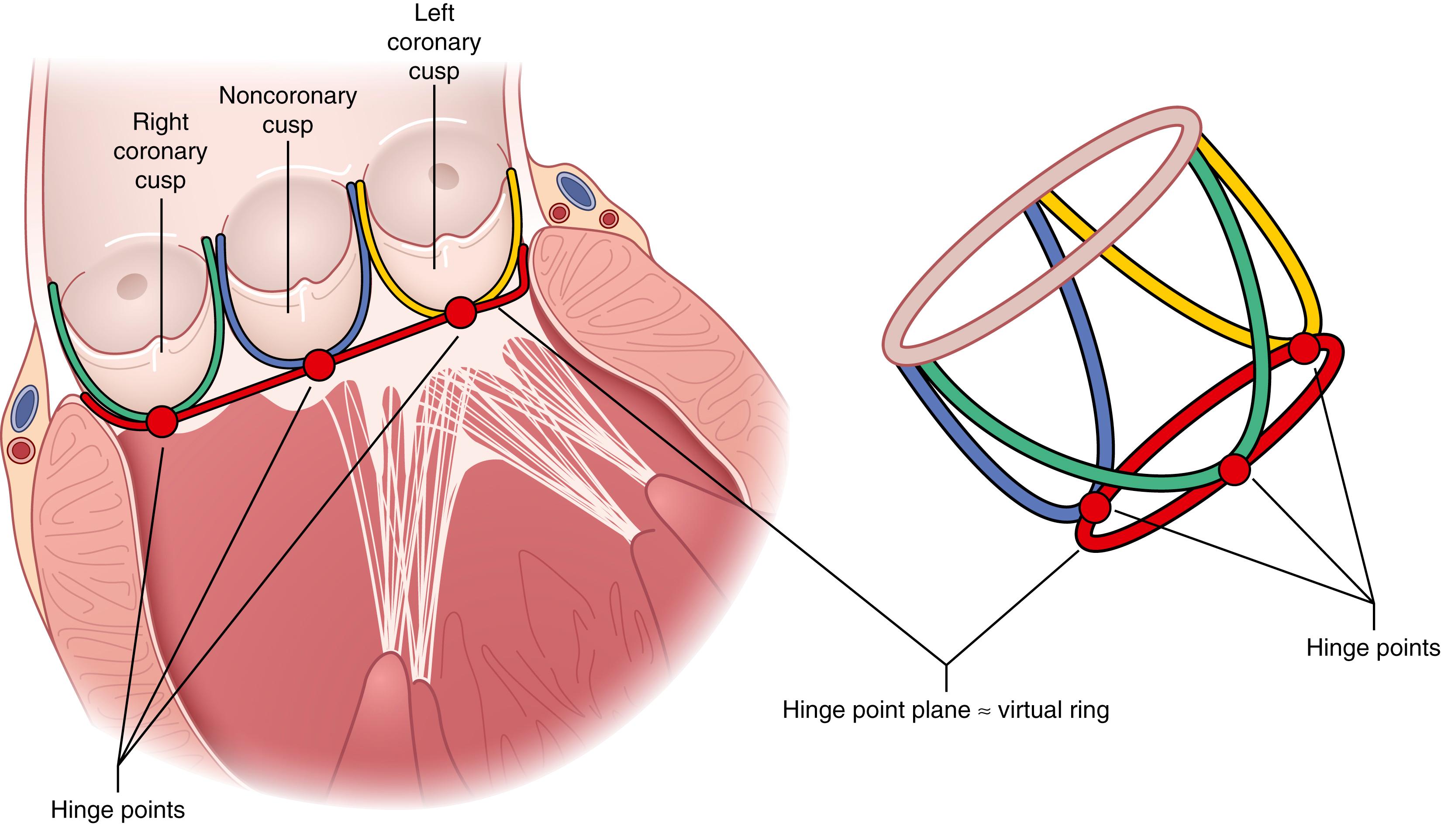 Fig. 61.4, Anatomy of the semilunar valves. Each valve is comprised of three cusps arising directly from the juncture of the great vessel and ventricular outflow tract walls.