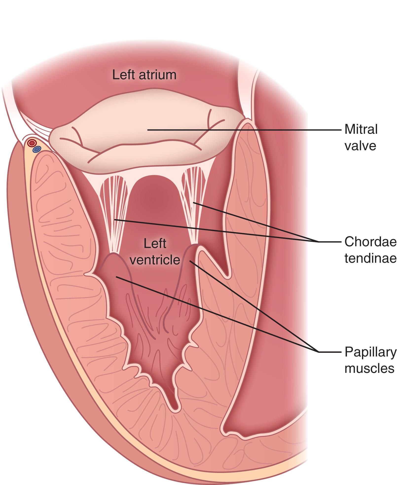 Fig. 61.6, Subvalvular apparatus of the atrioventricular valves. The mitral and tricuspid valves are supported by a robust subvalvular apparatus featuring the chordae tendinae that tether the leaflets and annuli to the papillary muscles which contract during systole to maintain leaflet coaptation and prevent leaflet prolapse into the atria.