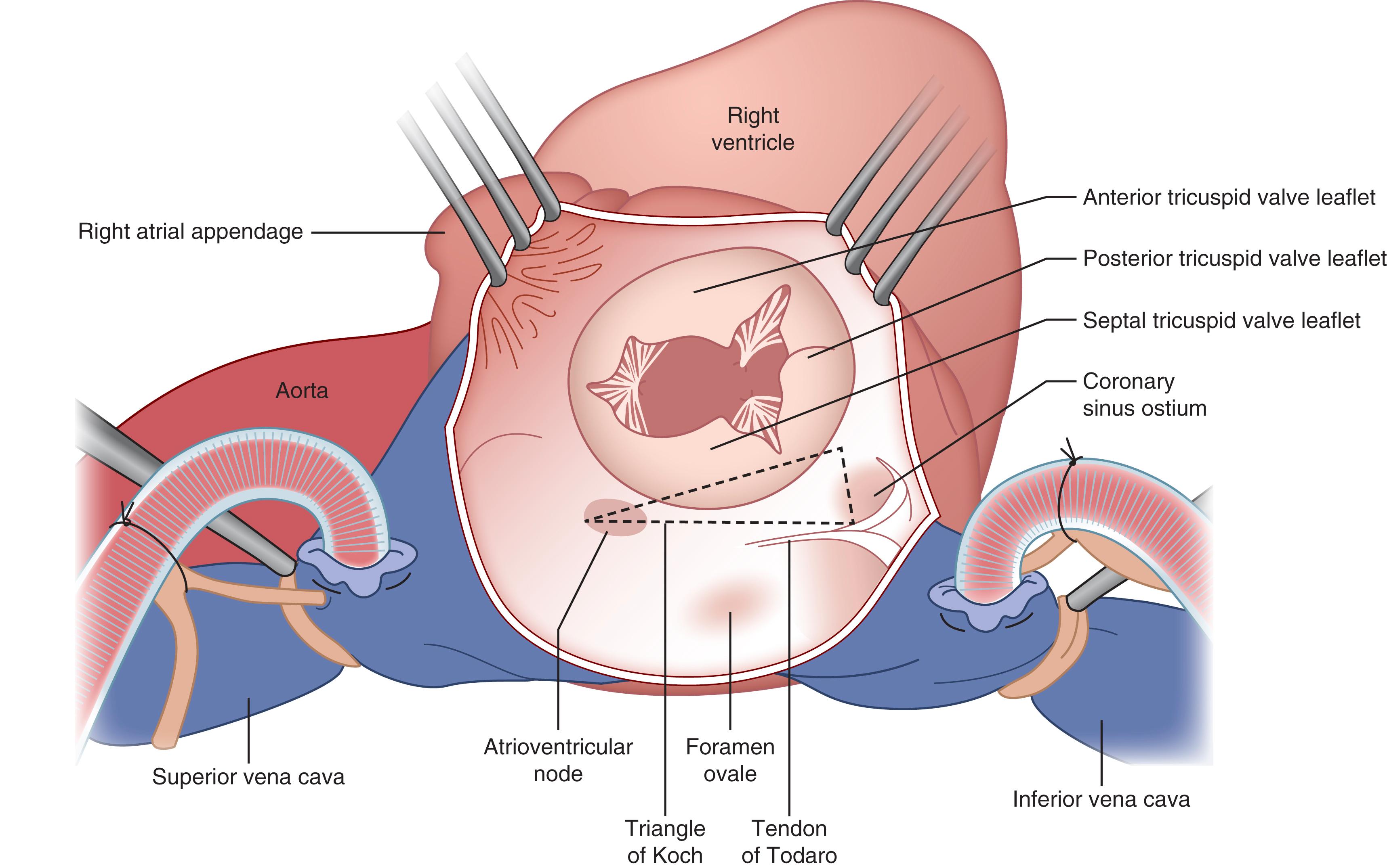 Fig. 61.10, Surgical anatomy of the tricuspid valve. The atrioventricular node lies in the apex of a triangular area first described by Koch, which is bounded by the septal annulus of the tricuspid valve anteriorly, the tendon of Todaro posteriorly, and the central fibrous body containing the bundle of His superiorly, leading to the coronary sinus inferiorly. (From Rogers JH, Bolling SF. The tricuspid valve: current perspective and evolving management of tricuspid regurgitation. Circulation. 2009;119:2718–2725.) A, Anterior tricuspid valve leaflet; AVN, atrioventricular node; CS, coronary sinus ostium; FO, foramen ovale; IVC, inferior vena cava; P, posterior tricuspid valve leaflet; RAA, right atrial appendage; RV, right ventricle; S, septal tricuspid valve leaflet; SVC, superior vena cava.