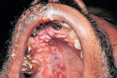 FIGURE 35-1, Herpes zoster involving the palate and lip in an HIV-infected patient.