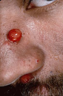 FIGURE 35-11, Red dome-shaped nodules of bacillary angiomatosis in an HIV-positive patient. The lesions have an appearance similar to pyogenic granulomas.