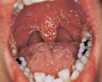 FIGURE 35-12, White friable plaques of oral candidiasis in a patient with AIDS.