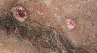 FIGURE 35-13, Cutaneous cryptococcosis in a patient with AIDS manifesting as multiple dome-shaped papules, some with central umbilication reminiscent of mollusca contagiosa.