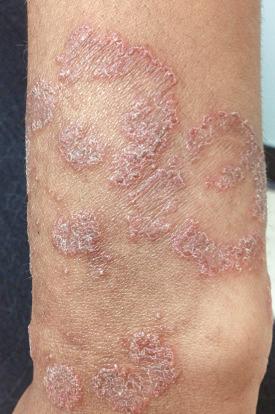 FIGURE 35-14, Annular erythematous scaly plaques of tinea corporis in an immunocompromised patient.