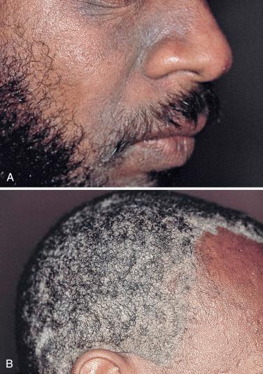 FIGURE 35-15, Seborrheic dermatitis characterized by scaling in ( A ) the nasolabial groove and ( B ) the scalp in two patients with AIDS.