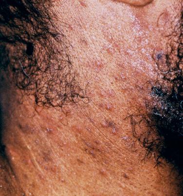 FIGURE 35-19, Pruritic lesions of eosinophilic folliculitis on the neck of a man with AIDS.