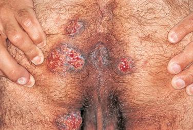 FIGURE 35-2, Chronic perianal ulcerations that represent herpes simplex infection in this HIV-infected man.