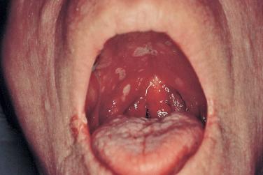 FIGURE 35-3, Multiple erosions on the hard and soft palate due to herpes simplex virus in an HIV-infected patient.