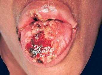 FIGURE 35-4, Multiple vesicles, some of which are hemorrhagic, on the tongue and upper lip of an HIV-infected patient. Note the scalloping of the border of the lesion on the lip that is characteristic of HSV infections.