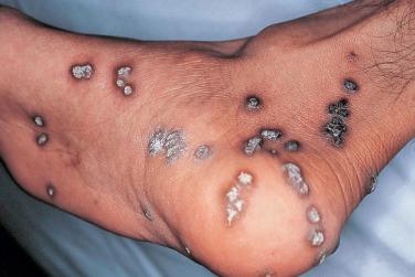 FIGURE 35-5, Verrucous papules of chronic varicella-zoster virus (VZV) in a patient with AIDS.