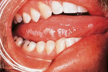 FIGURE 35-6, Oral hairy leukoplakia.
