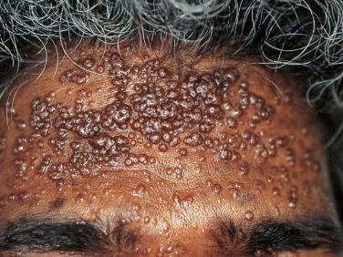 FIGURE 35-7, Numerous dome-shaped papules of mollusca contagiosa on the forehead of an HIV-infected patient. Note the central dell in several of the lesions.
