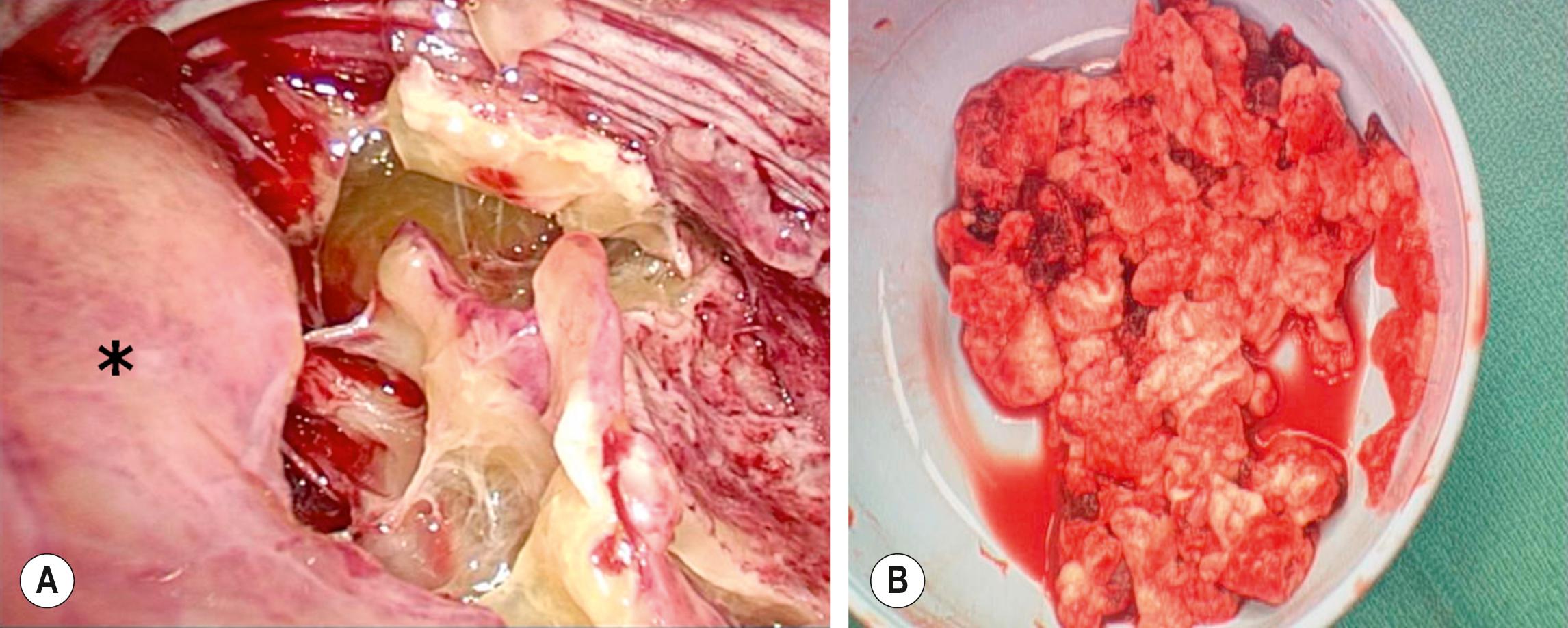 Fig. 23.1, (A) The thoracoscopic view shows the inflammatory septations that can develop with empyema. The collapsed lung is marked with an asterisk. (B) Note the thick, solid purulent material that is often found in these patients.