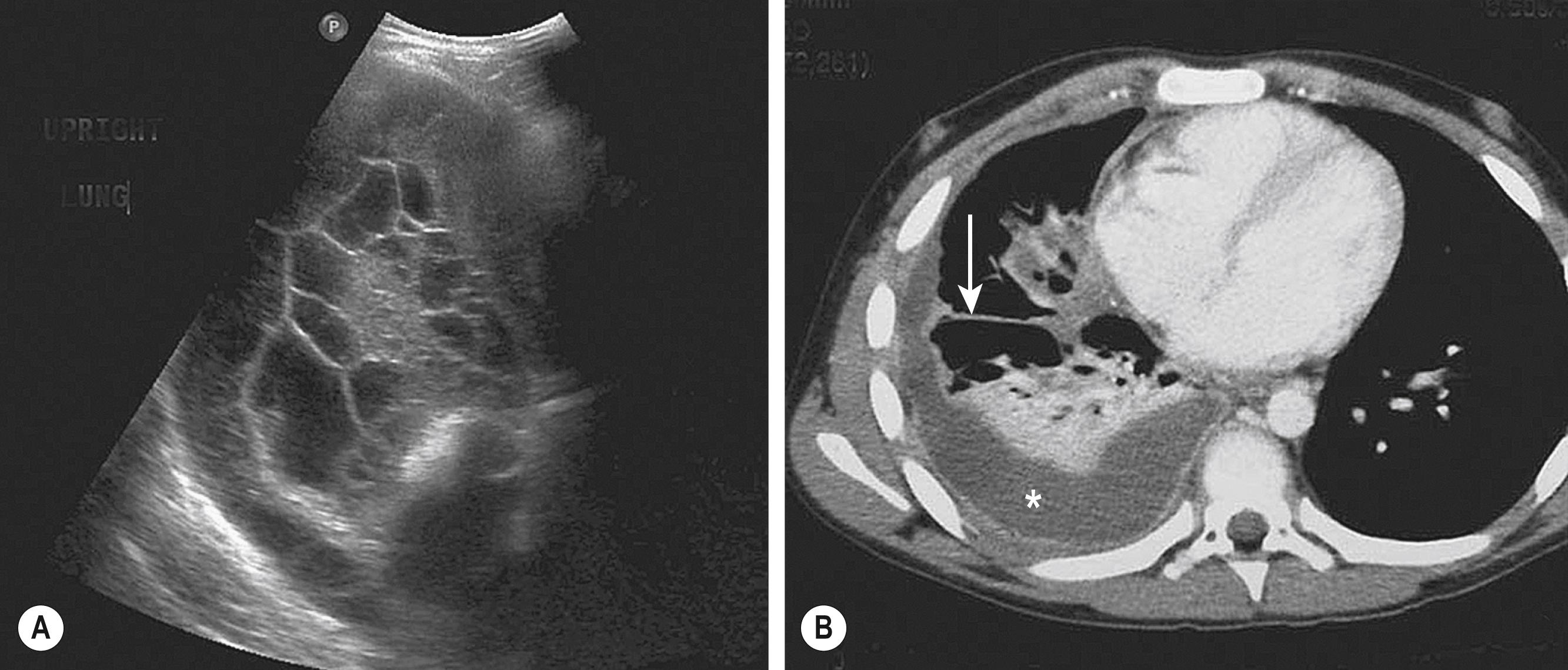 Fig. 23.2, Ultrasonography and/or CT of the chest are helpful during the initial evaluation of children with a pleural effusion and possible empyema. (A) In the ultrasound study, note the loculations identified in the pleural fluid. (B) On the CT scan, a large pleural effusion (asterisk) is noted. Also there is collapse of the underlying lung parenchyma as well as septations (arrow).