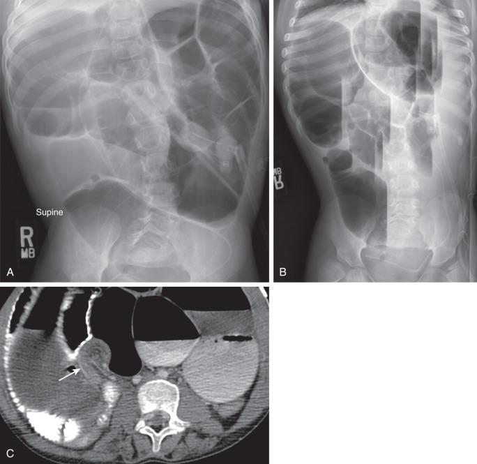 Figure 104.1, Small bowel obstruction caused by adhesions.