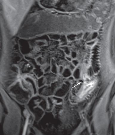 Figure 104.12, Crohn disease enterocolic fistula and terminal ileitis.